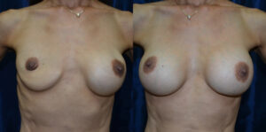Patient 2b Breast Revision Before and After
