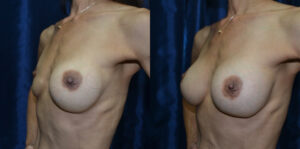 Patient 2d Breast Revision Before and After