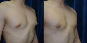 Patient 3b Gynecomastia Before and After