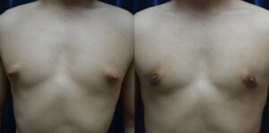 Patient 3c Gynecomastia Before and After