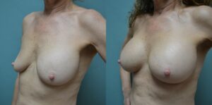 Patient 1b Breast Revision Before and After