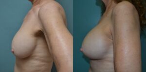 Patient 1c Breast Revision Before and After