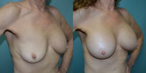 Patient 1d Breast Revision Before and After