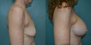 Patient 1e Breast Revision Before and After