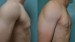 Patient 1b Gynecomastia Before and After