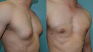 Patient 1c Gynecomastia Before and After