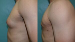 Patient 1d Gynecomastia Before and After