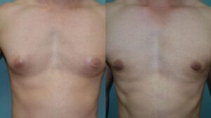 Patient 1a Gynecomastia Before and After