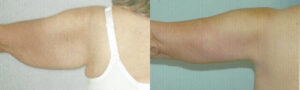 Patient 1a Arm Lift Before and After