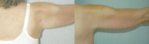 Patient 1b Arm Lift Before and After