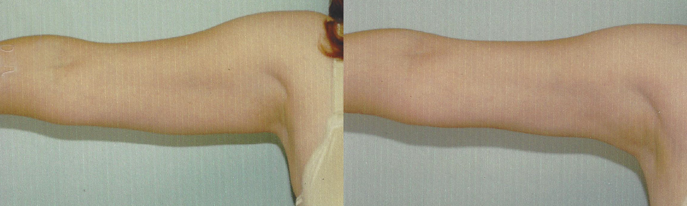 Patient 2a Arm Lift Before and After