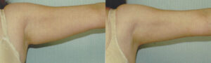 Patient 2b Arm Lift Before and After