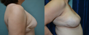 Patient 1c Breast Reconstruction