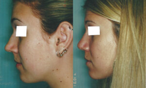 Patient 3a Rhinoplasty Before and After