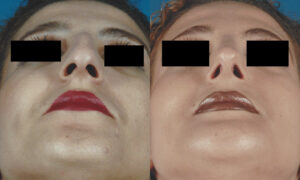 Patient 1c Rhinoplasty Before and After