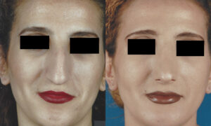 Patient 1b Rhinoplasty Before and After