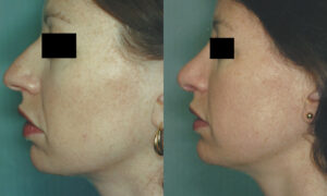 Patient 2a Rhinoplasty Before and After