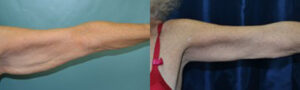 Patient 4a Arm Lift Before and After