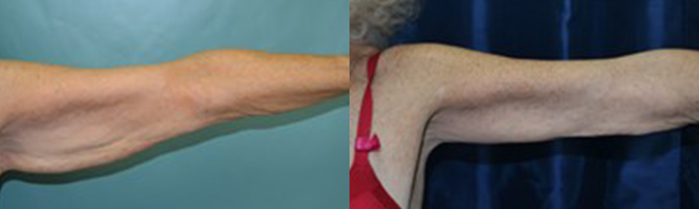 Patient 4a Arm Lift Before and After