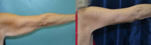 Patient 4b Arm Lift Before and After