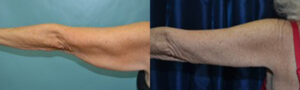 Patient 4d Arm Lift Before and After