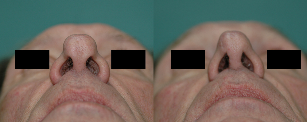 Patient 5 Rhinoplasty Before and After