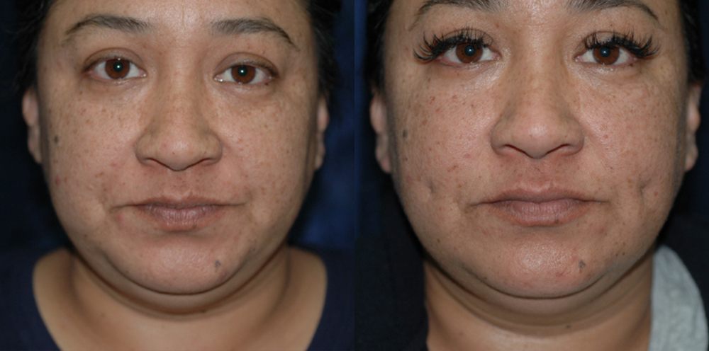 Patient 1 Dimpleplasty Before and After