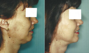 Patient 1 Liposuction Before and After