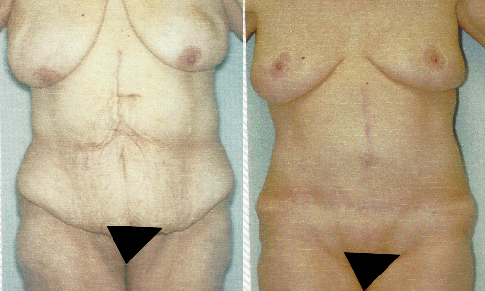 Patient 1a Body Lift Before and After