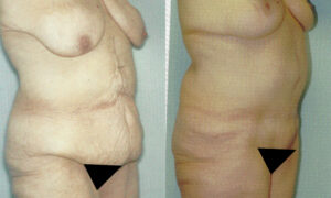 Patient 1b Body Lift Before and After