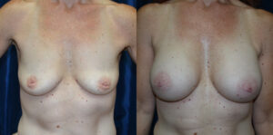 Patient 17c Breast Augmentation Before and After