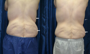 Patient 1 CoolSculpting Before and After