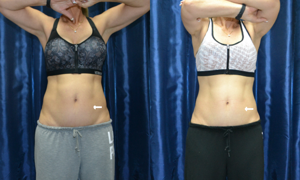 Patient 2 CoolSculpting Before and After