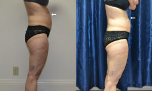 Patient 3a CoolSculpting Before and After