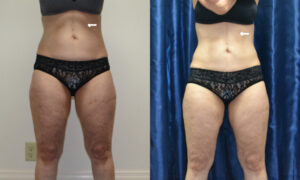 Patient 3b CoolSculpting Before and After