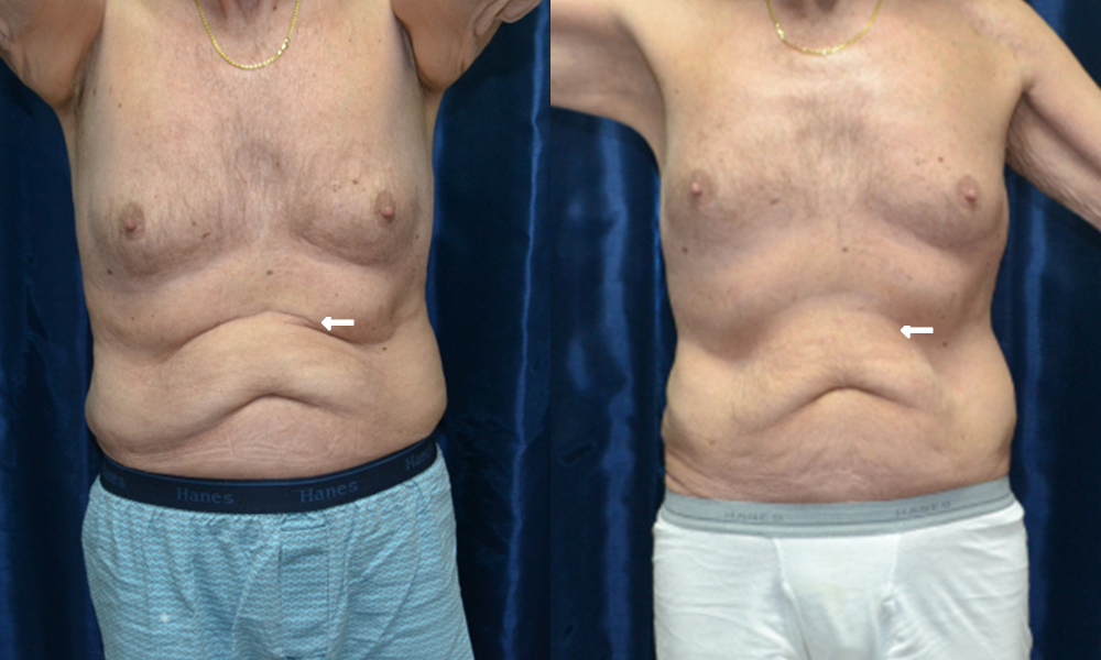 Patient 4 CoolSculpting Before and After
