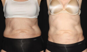 Patient 7a CoolSculpting Before and After