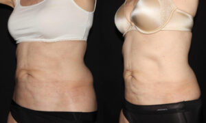 Patient 7b CoolSculpting Before and After