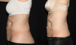 Patient 7c CoolSculpting Before and After