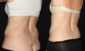 Patient 7d CoolSculpting Before and After