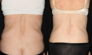 Patient 7e CoolSculpting Before and After
