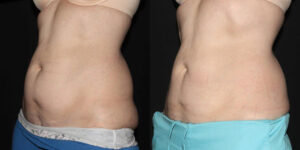 Patient 8a CoolSculpting Before and After