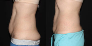 Patient 8c CoolSculpting Before and After