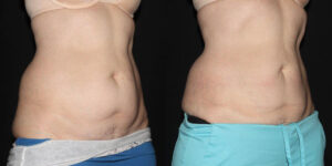 Patient 8d CoolSculpting Before and After