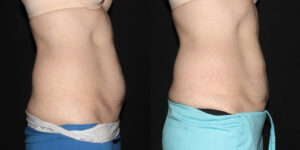 Patient 8e CoolSculpting Before and After