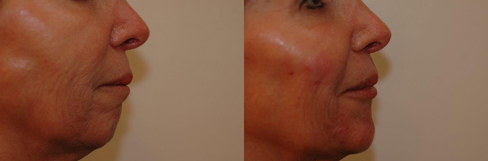 Patient 1 Radiesse® Before and After
