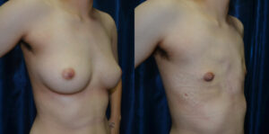 Patient 7c Transgender Plastic Surgery Before and After