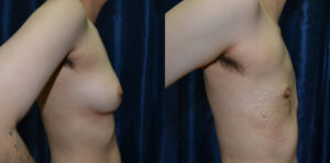 Patient 7b Transgender Plastic Surgery Before and After
